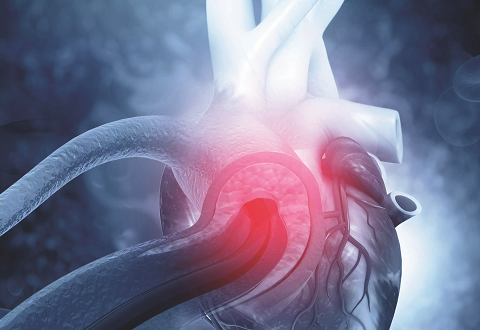 NHCS Aortic Clinic: A Dedicated Hub For Aortic Diseases